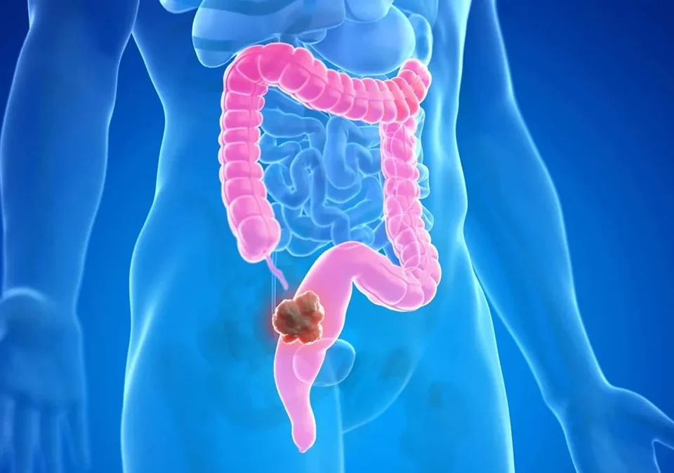 drpsathas-ioannis-psathas-genikos-xeirourgos-athina-karkinos-paxeos-enterou-featured