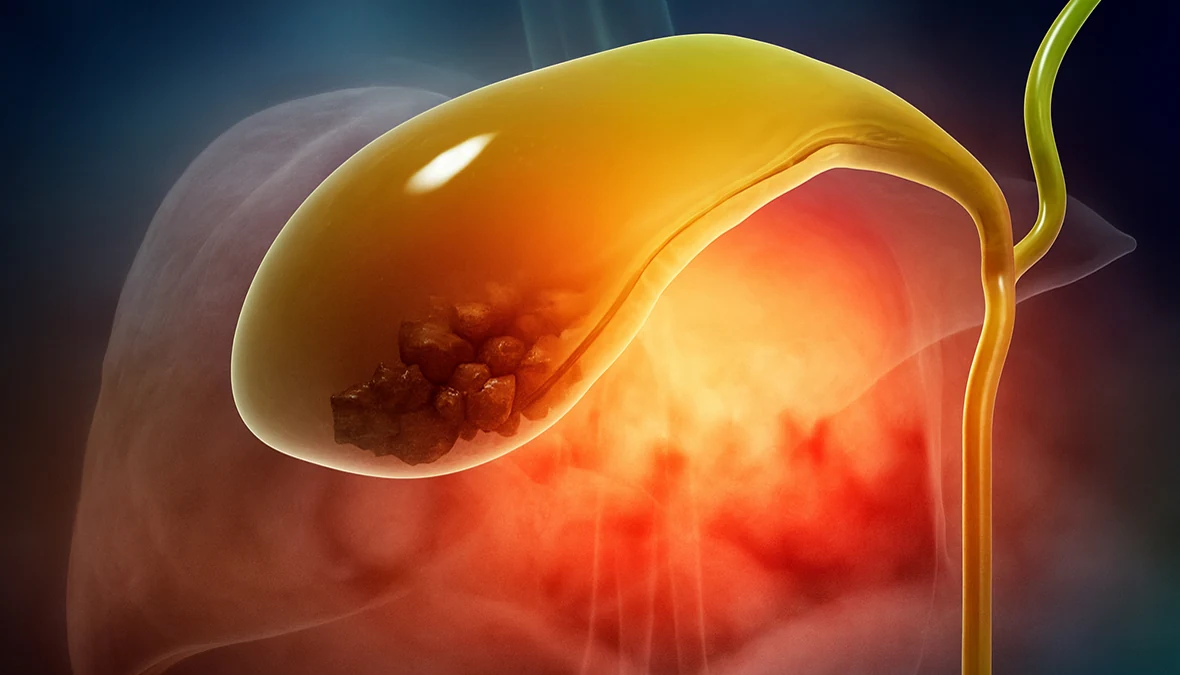 drpsathas-ioannis-psathas-genikos-xeirourgos-athina-xololithiash-petres-xolh-featured